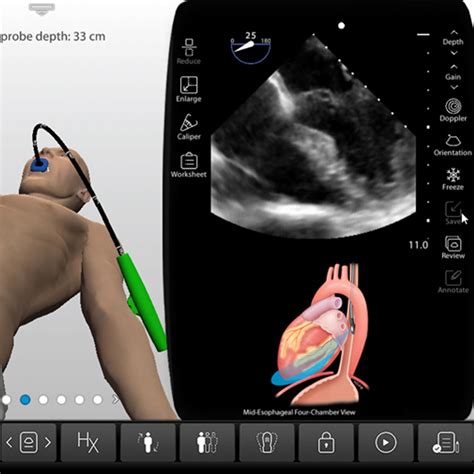 Transesophageal Echocardiogram Procedure