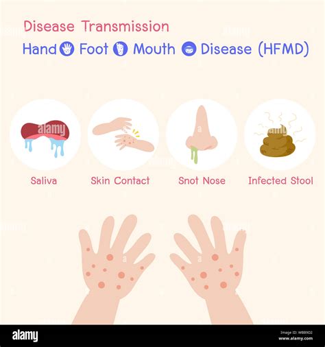 Transmission Modes of Hand Foot Mouth Disease