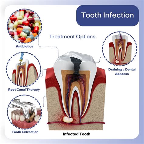 Treating Dental Infections