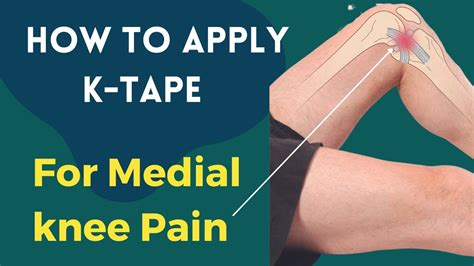 Treating MCL Injuries