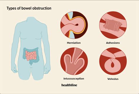 Treating Obstruction with Medication
