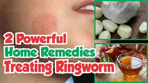 Treating Ringworm in Pets