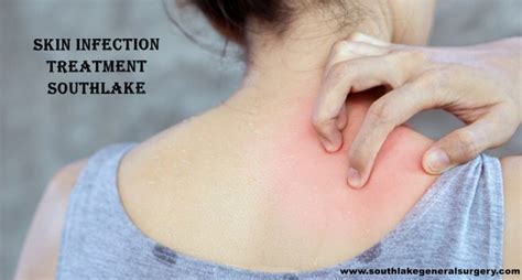Treating Skin and Soft Tissue Infections