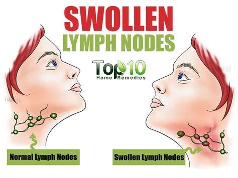 Treating Swollen Lymph Nodes