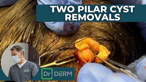 Treating a Cyst