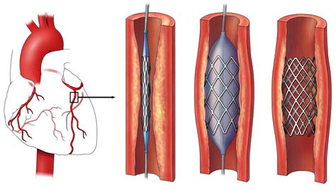 Treatment After Coronary Stent Placement