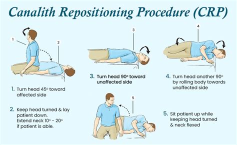 Treatment Methods for BPPV