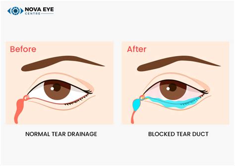 Treatment Options for Blocked Tear Duct