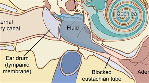 Treatment Options for Fluid Buildup In Ear