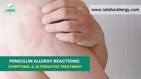Treatment Options for Penicillin Allergies