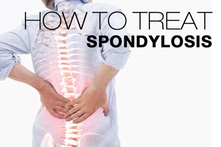 Treatment Options For Spondylosis