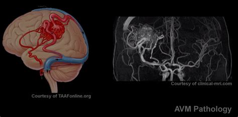 Treatment Options for Brain AVMs
