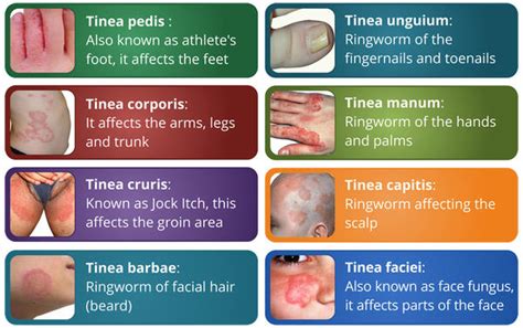 Treatment Options for Different Types of Ringworm