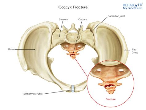 Treatment Options for Fractured Coccyx