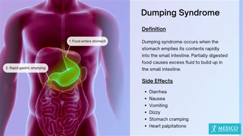 Treatment Options for Gastric Dumping Syndrome