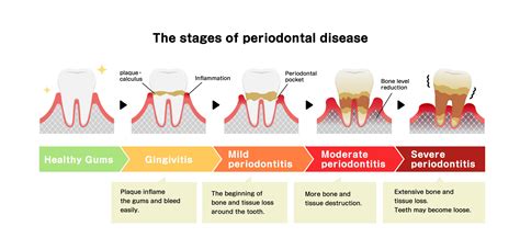 Treatment Options for Gum Disease