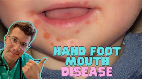 Treatment Options for Hand Foot Mouth Blister