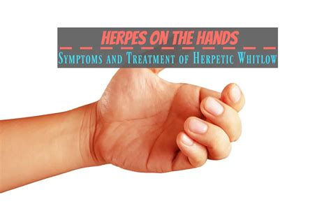 Treatment Options for Herpes on Finger