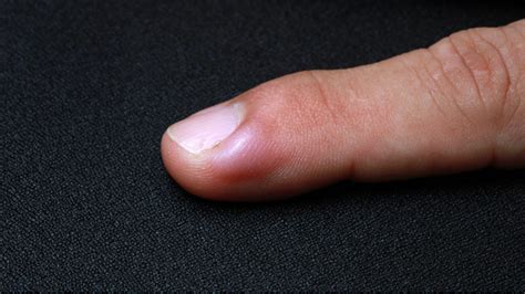 Treatment Options for Swollen Finger Around Nail