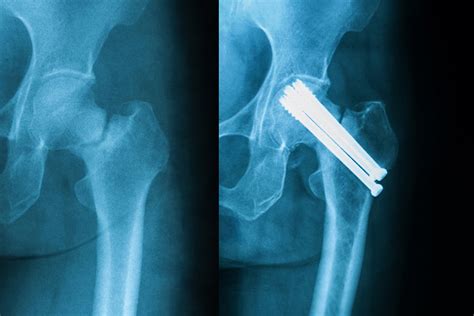Treatment Options for a Broken Hip