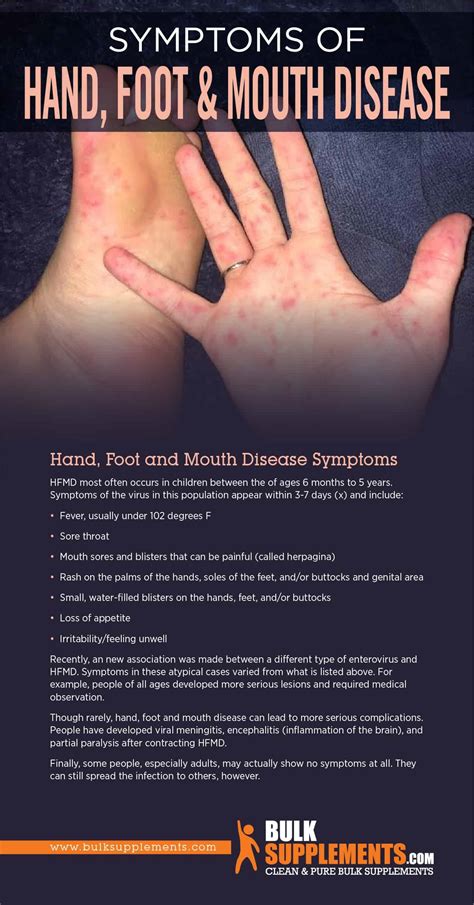 Treatment and Management of Hand Foot Mouth Disease