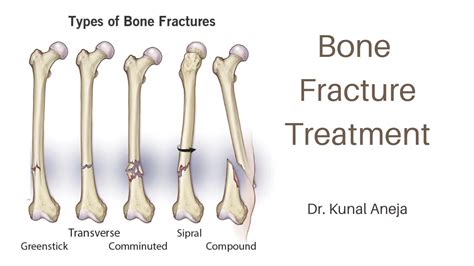 Treatment of Bone