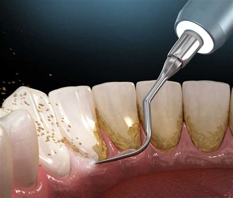 Treatment of Dental Plaque