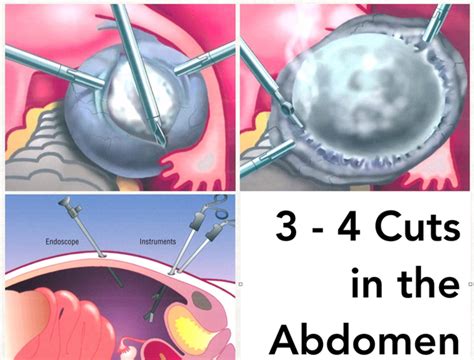 Treatment of Perforated Ovarian Cyst