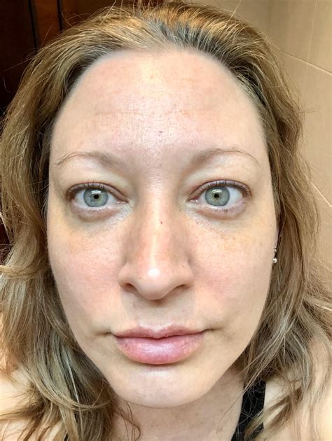 Treatment of Yellow Skin and Eyes