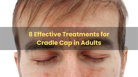 Treatments For Cradle Cap On Face