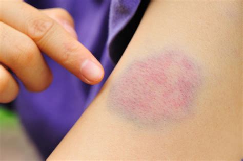 Treatments for Bruises