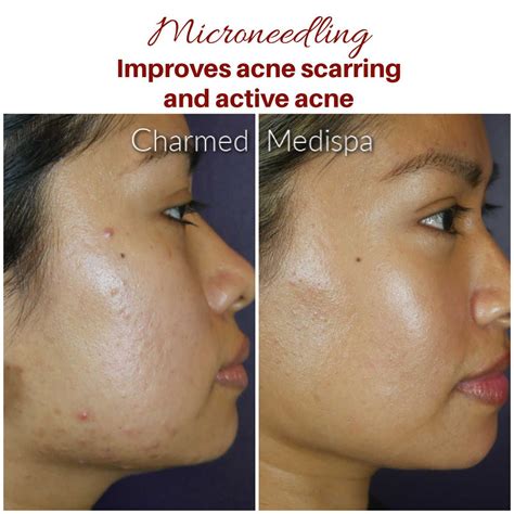 Treatments for Reducing Scarring