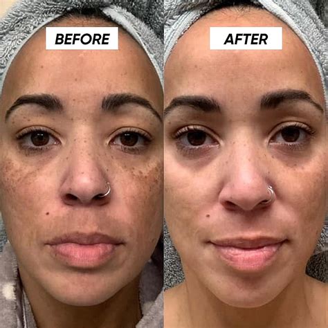 Tretinoin Cream for Hyperpigmentation