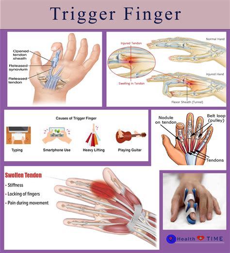 Trigger Finger Symptoms
