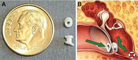Tympanostomy Tubes