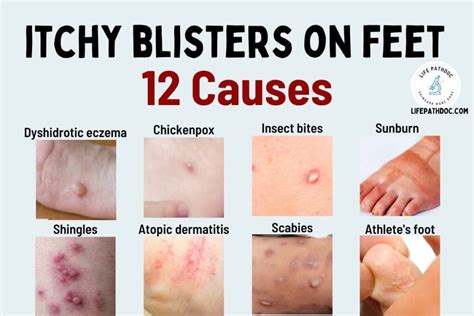 Types Of Blisters On Feet