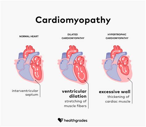 Types Of Cardiomyopathy