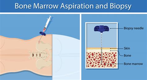Types of Bone Marrow Examination