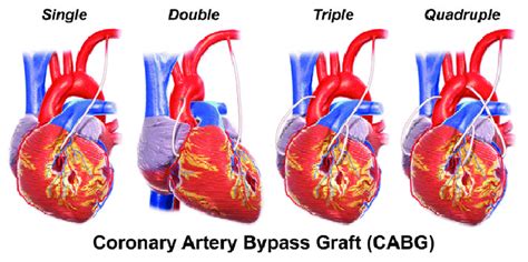 Types of Bypass Surgery