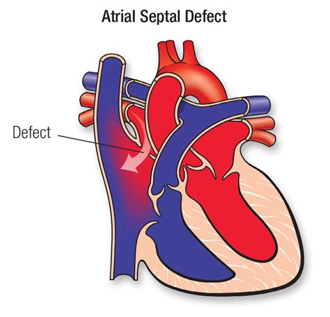 Types of Heart Defects Associated with ASD