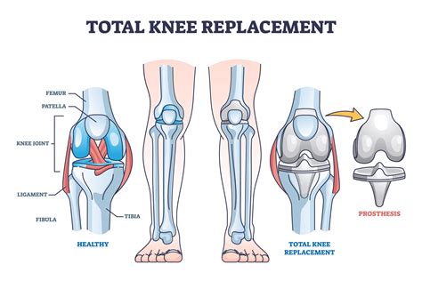 Types of Knee Replacement Surgeries