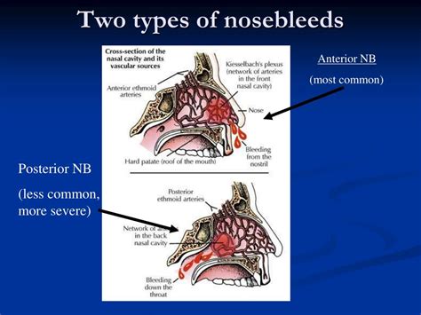 Types of Nosebleeds