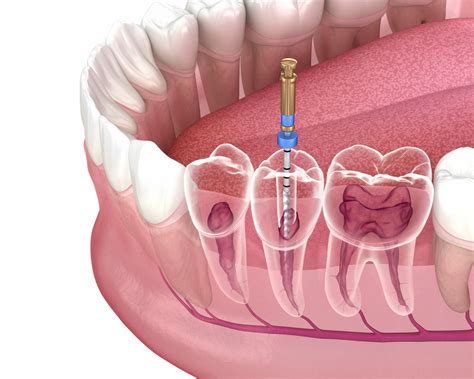 Types of Root Canal Surgery