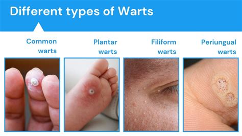 Types of Warts