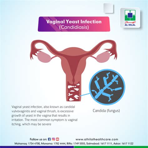 Types of Yeast Infections
