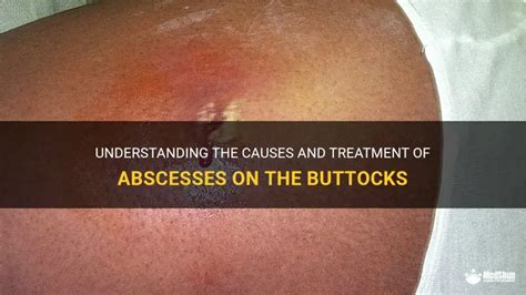 Understanding Abscesses