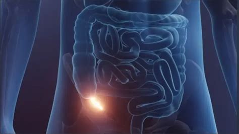 Understanding Appendicitis