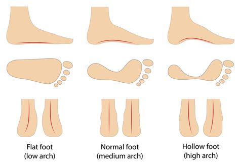Understanding Arch Pain