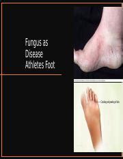 Understanding Athlete's Foot