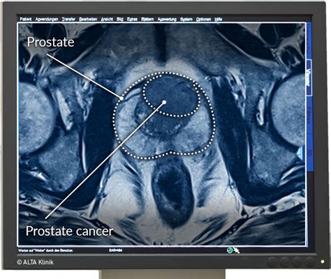 Understanding BPH